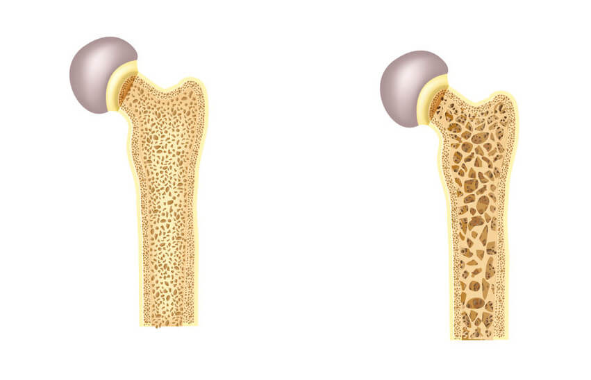 Yamswurzel bei Osteoporose